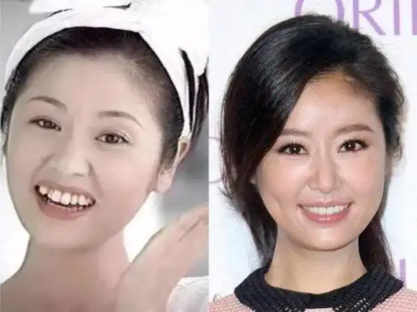 韩国女明星整容前后的对比,明星矫正牙齿对比照片大全 - 歌词译