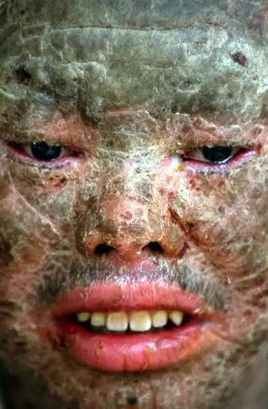 震惊!云南男子患怪病浑身上下长满鱼鳞,吓坏小朋友!