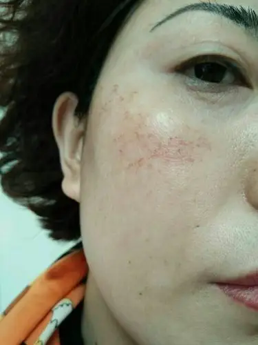 庆城县珈黛加盟连锁店专业治疗红血丝案例……图为我本人……疗肤微信