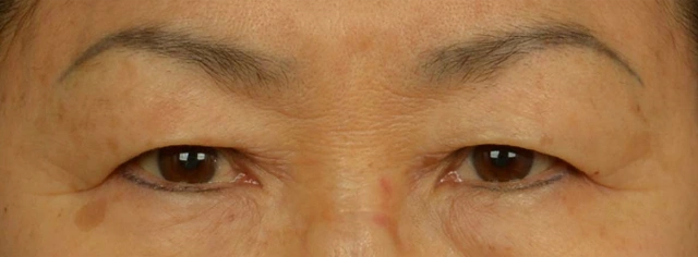 吕晓杰:眼皮松弛下垂的三种情况,每一种都能拉低颜值!-吕晓杰副主任医