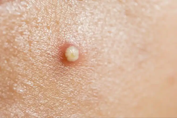 女性阴部毛囊炎的症状图片(私处长痘千万别抠) - 赤虎壹号