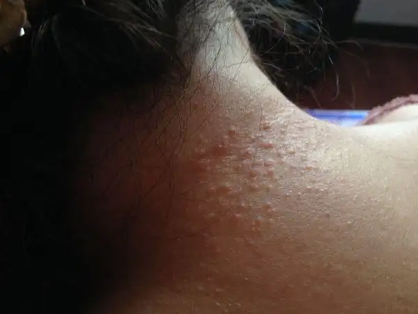 暂未定制 按默认排序|其他1条回答 2013-08-10 14:39|九级 接触性皮炎