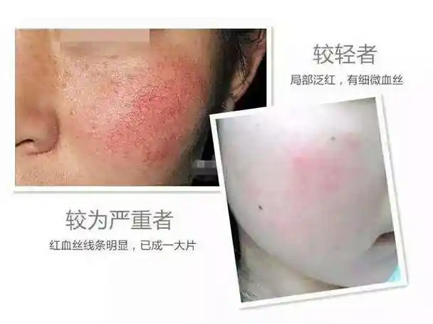 我的皮肤角质层薄有红血丝该怎么办?