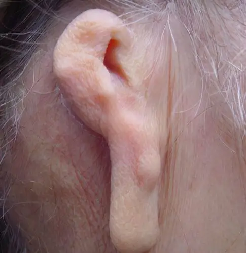 畸形|耳廓|皮瓣_网易订阅