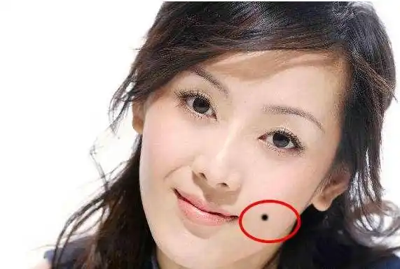 这几处长痣千万不要留!天生的"破财痣",赶紧点掉!