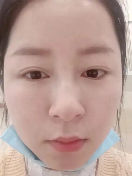 脂肪填充泪沟第11天