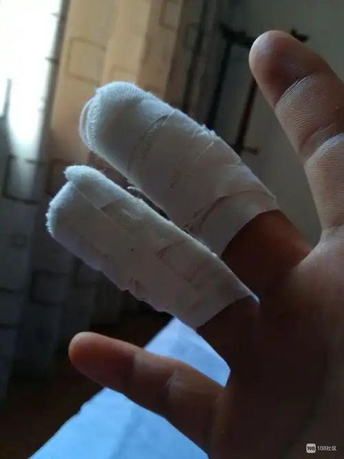 干活中伤了2个手指头,德清社友手术直播!告诫大伙注意安全