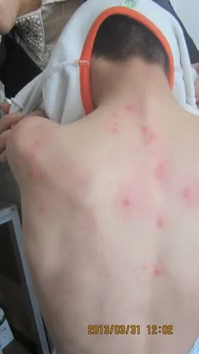 丘疹性荨麻疹一例春季皮肤病病例征集