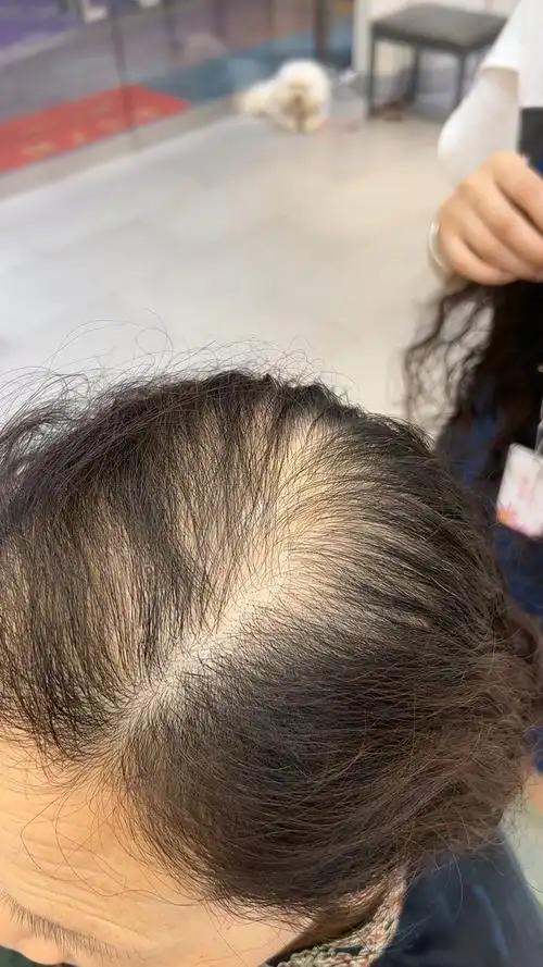 解决发量稀少问题!