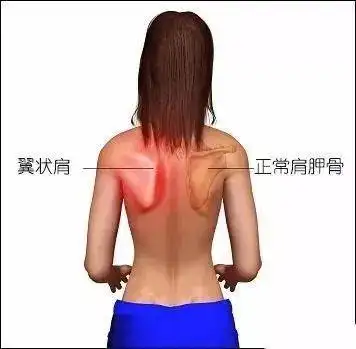 菱形肌,前锯肌,斜方肌中下束无力 ,就会导致肩胛骨外翻,它就会异样的