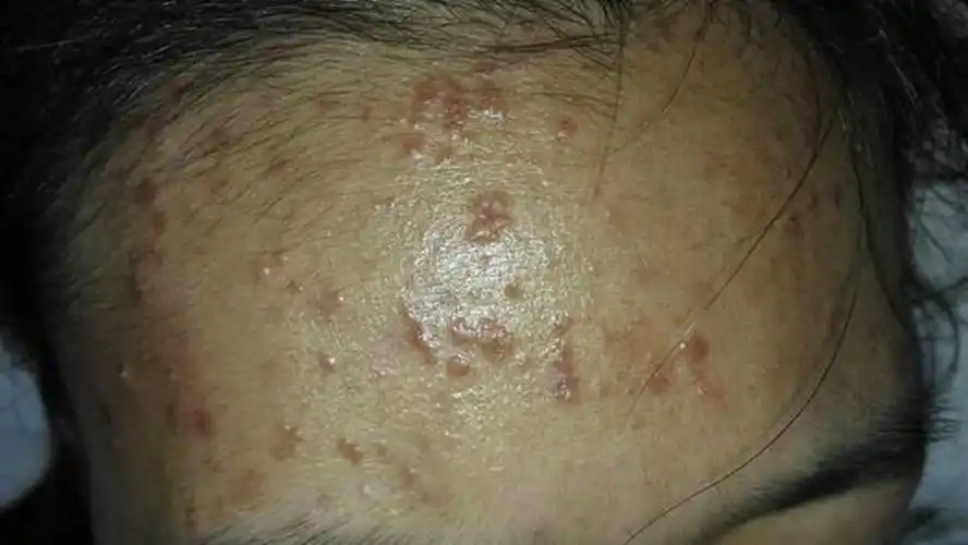 疣图片_疣症状表现图片大全_有来医生