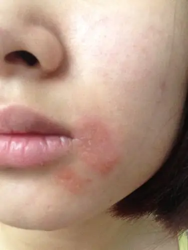 皮肤痒,一到晚上就爱抓,红肿,会扩散一样还起皮,已经一个月了