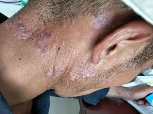 慢性日光性皮炎(慢光化)