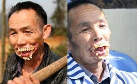 遭狼袭击中狼牙之毒而被毁容的人牙齿全部外露超吓人
