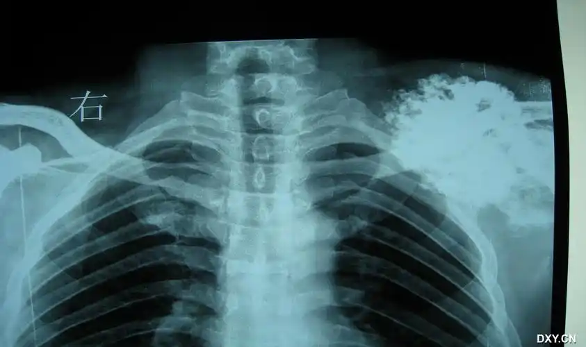 一例肩胛骨肿物的讨论(较少见)