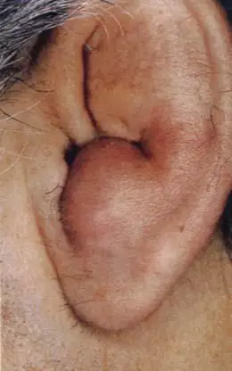 耳廓假性囊肿(图片)