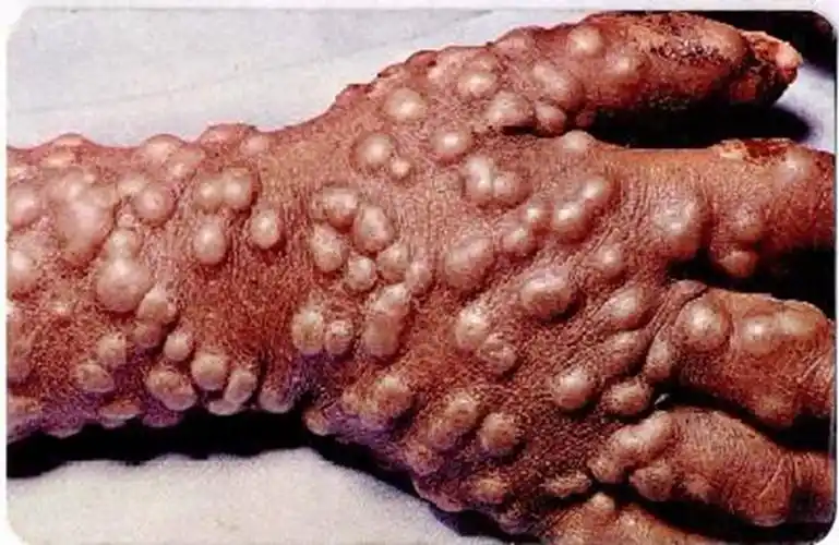 天花是一种严重的传染性疾病,患病后常会引起严重毒血症;病情好转后