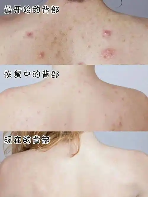 毛囊里积年累月的脏东西被清理掉,久用之后会发现,反复爆发的痘痘都被