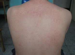 脂溢性皮炎能治愈吗 得了脂溢性皮炎怎么办脂溢性皮炎能治愈吗?