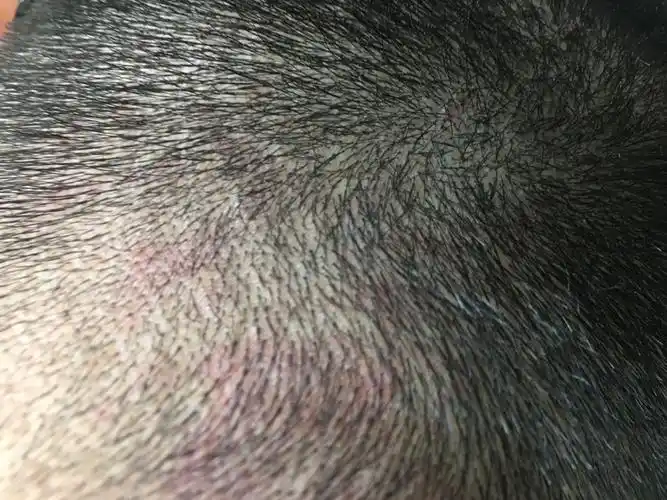 我的头皮起了些红色东西,不知道是不是毛囊炎,麻烦帮我看下