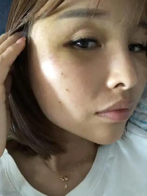 做了自体脂肪填充后,眼部周围淤青,眼窝下方都是肿的,会消吗,今天第五