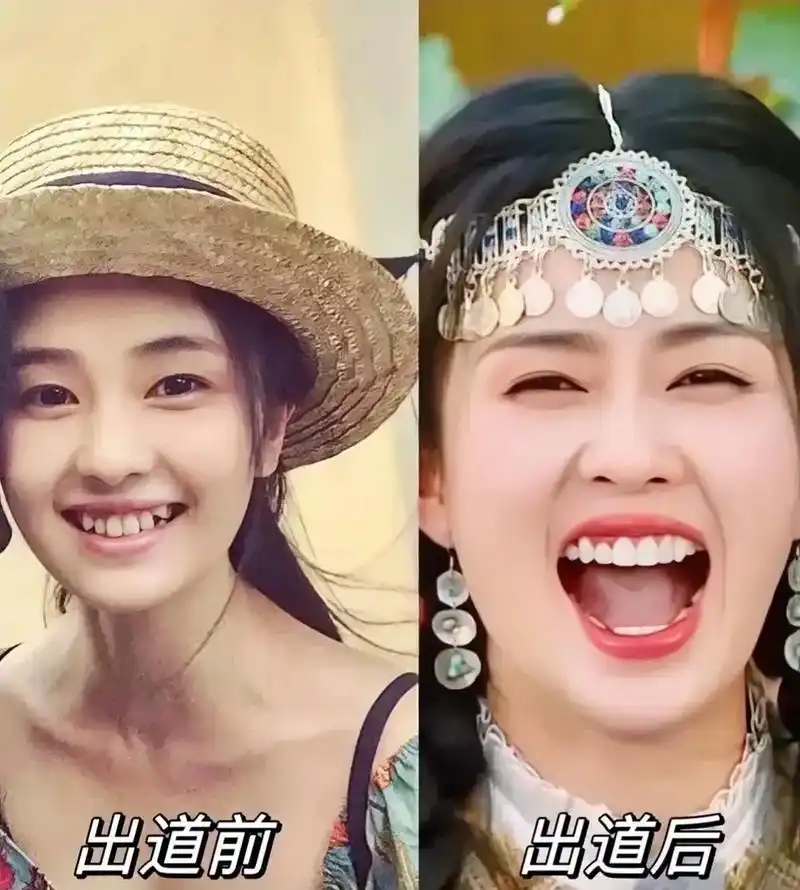 出道后把牙整了,笑起来真的是肆无忌惮.你觉得整牙前后哪个更好看呢?