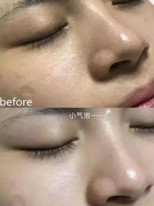 快速去黑头收缩毛孔医美攻略