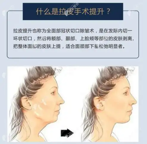 面部拉皮手术的切口位置