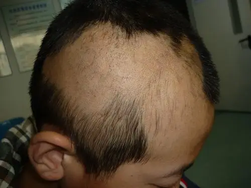 病例图片分享——拔毛癖