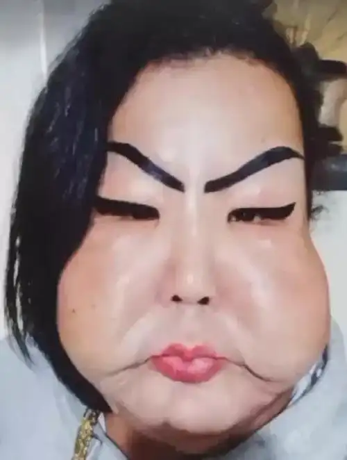 女子贪小便宜导致整容失败如今脸像戴上鬼面具