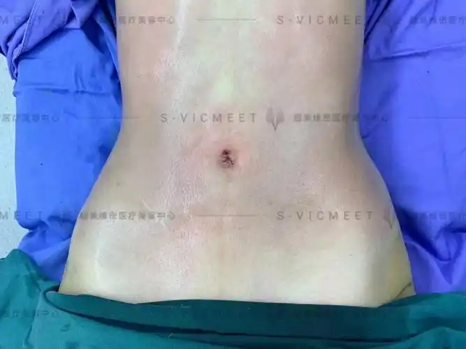 这次吸脂手术效果我挺满意的,罪没白受,腰和肚子瘦