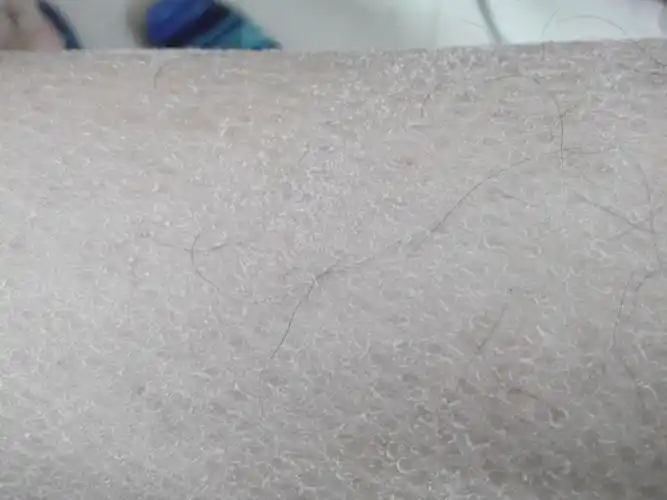 秋天皮肤干燥,发白,掉皮,有什么好的改善方法吗