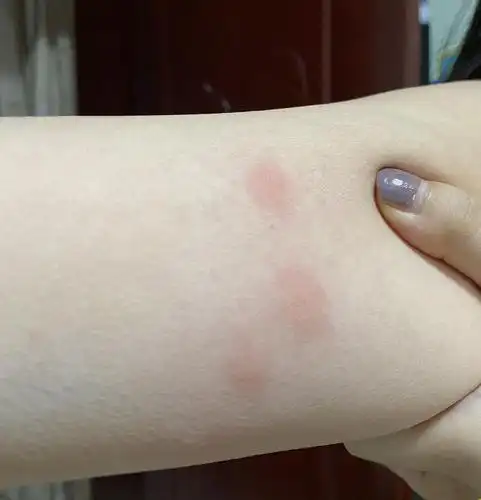 【讨论】这是被跳蚤咬的吗(有图慎入)