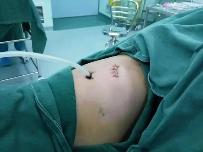 微创手术-三孔胸腔镜切口微创手术-三孔胸腔镜切口开胸手术切口开胸