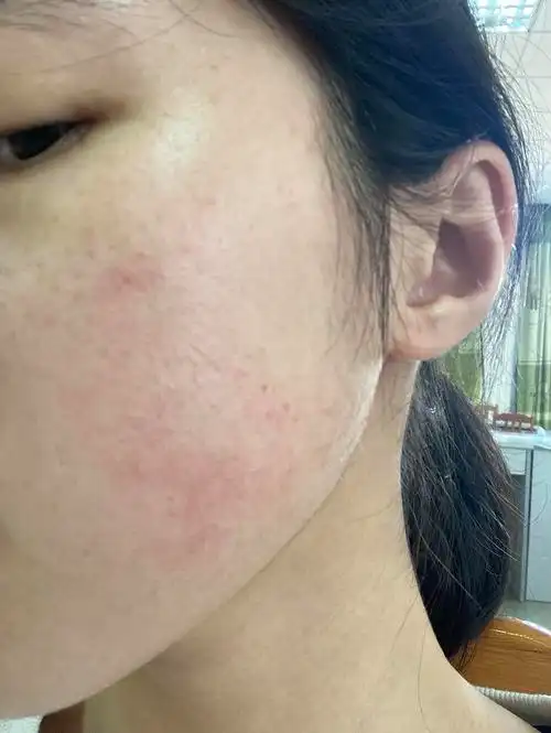 为什么俺的脸会痒而且红块越来越大了00