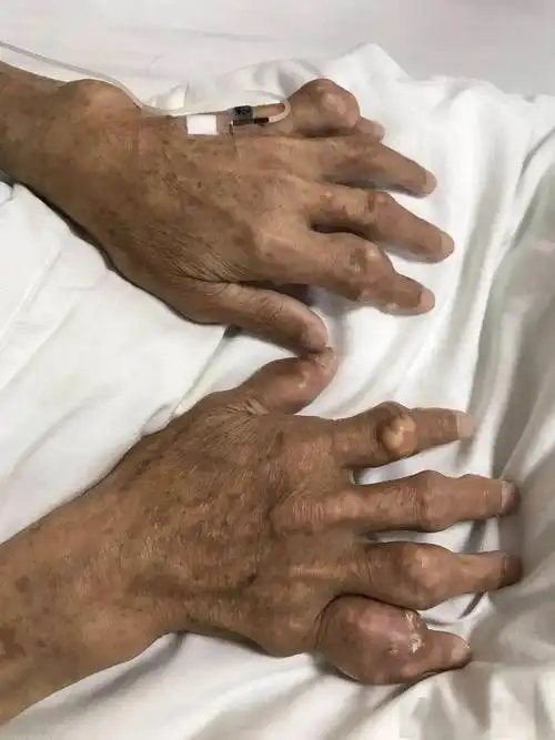 比"没有麻醉生孩子"还疼?这病越来越多年轻人"中招"……_尿酸