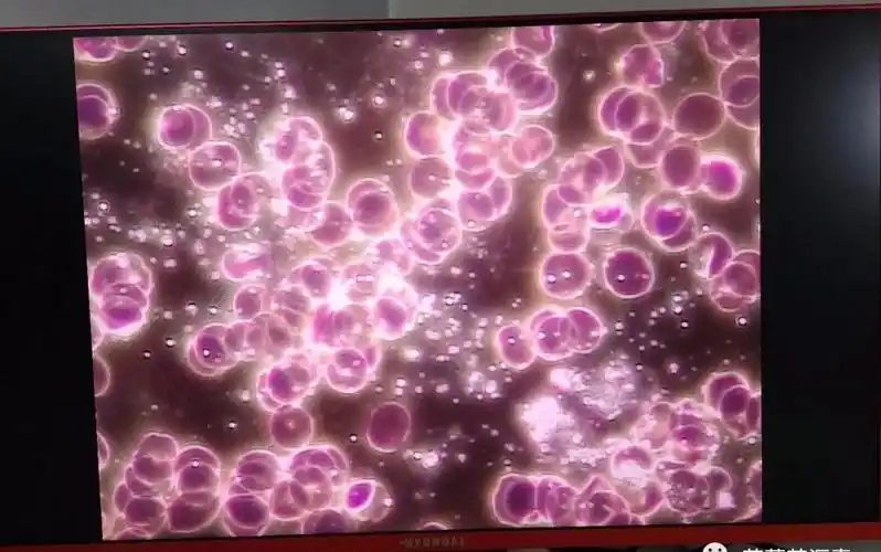 血液中糖偏高另一个类似后勤保障功能的,就是血红细胞;若红细胞聚集在