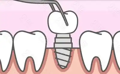 三位牙友反馈种牙经历,告诉你广州天河哪里做种植牙好!