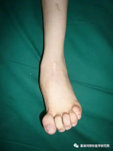 对于严重足踝畸形残缺,西方足踝重建技术体系建议截肢后安装假肢.