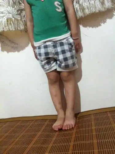 2014-03-23 李翠英 医师 在医院检查有o形腿,呈内八字!