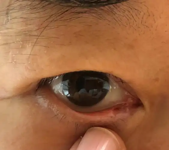 下眼睑内侧累及泪点的色素痣的手术切除和治疗原则_眼睑色素痣_症状