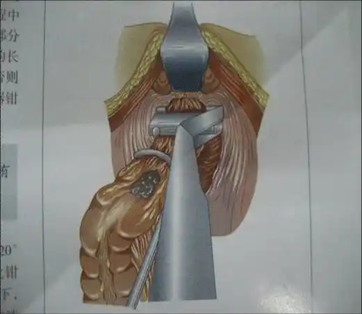 保肛手术—腹腔镜保肛结肠拉出术  直肠癌保肛术要求直肠系膜全切除