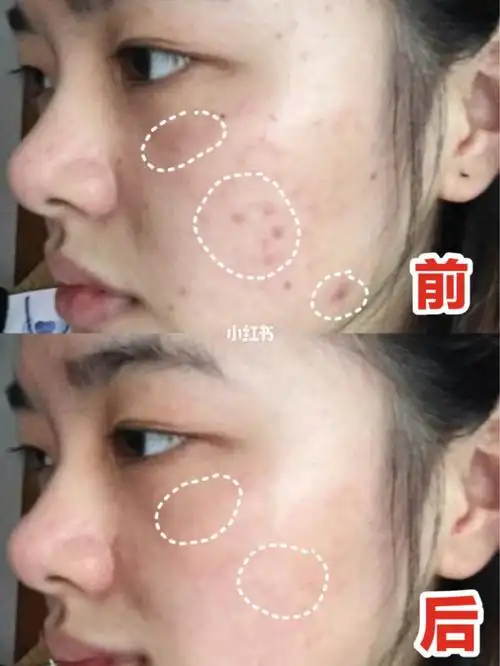 祛痘去痘印这么简单75方法真的很重要