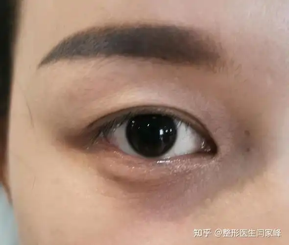 被误诊为"上睑下垂"的"重症肌无力" - 知乎