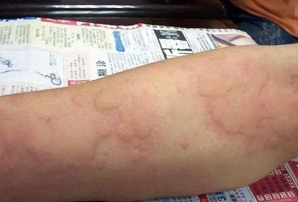 肝病不痛不痒,等发现就是肝癌晚期,若身上长此物,得赶紧查查