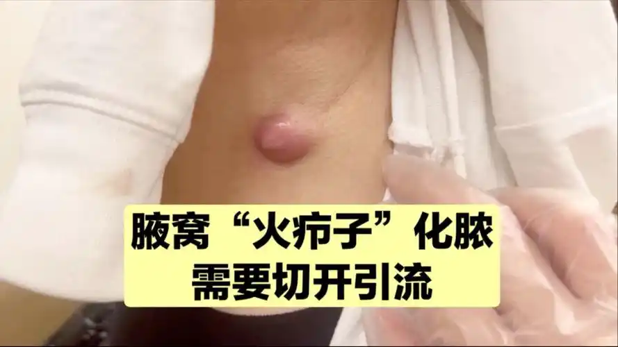 "火疖子"形成脓肿了,只能切开引流,把脓放出来