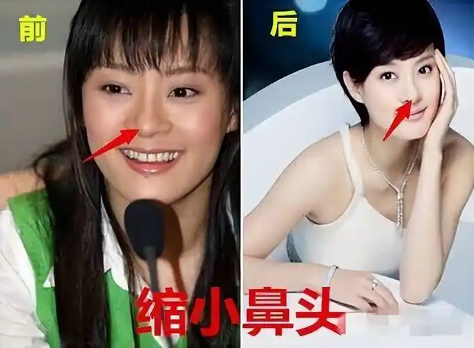 孙俪称自己确实整过容,自爆塌鼻梁是用夹子夹尖的!_张嘉倪_因为_牙齿