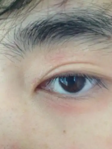 为什么一早起来眼睛变成这个样子了 从正常的 变成眼