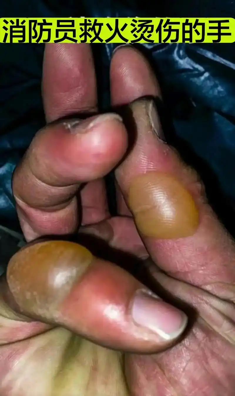 消防员守护人民的手@伤疤记录荣誉.#消防员#中国消防为 - 抖音
