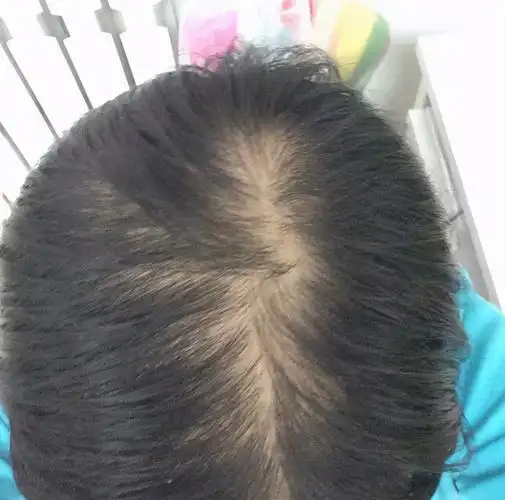 20岁新手宝妈产后脱发,头顶都快秃了,如今愁到奶水也快要断了_手机